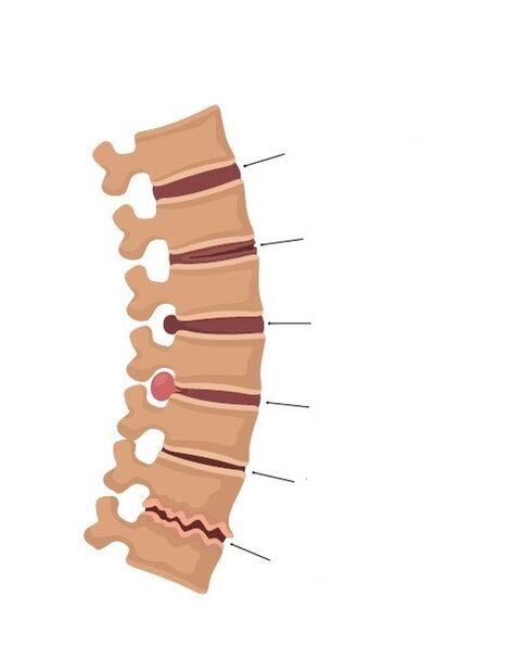 Cambios óseos na columna vertebral