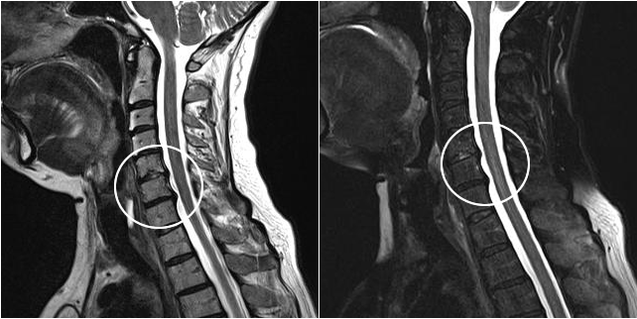 Osteocondrose cervical na resonancia magnética