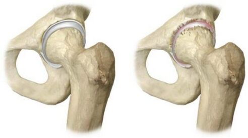 articulación sa da cadeira afectada pola artrose